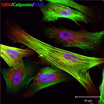 Seen through a microscope, these color-enhanced skin cells from progeria patients have been induced to become smooth muscle cells, some with abnormalities such as double nuclei. [Credit: Haoyue Zhang]
