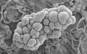 Ovarian cancer cells