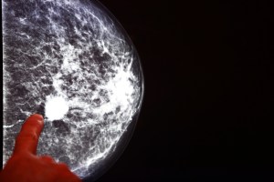 Some forms of breast cancer tumors can actually turn the body's own immune system against itself.