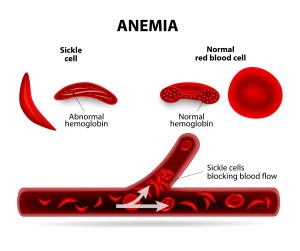 In Sickle Cell Disease, the misshapen red blood cells cause painful blood clots and a host of other complications. 