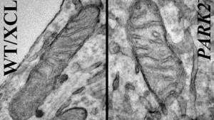 Mitochondria from iPSC-derived neurons. On the left is a neuron derived from a healthy individual, while the image on the right shows a neuron derived from someone with the Park2 mutation, the most common mutation in Parkinson's disease (Credit: Akos Gerencser)