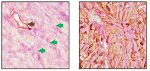 Two adjacent sections of a mouse breast tumor. Tissue at left is stained so that normal blood vessels can be seen (black arrow). Extending from these vessels are blood filled channels (green arrows). On the right, the tissue is stained for a fluorescent protein expressed by the tumor cells. Here, blood-filled channels are actually formed by tumor cells in a process known as vascular mimicry. [Credit: Hannon Lab, CSHL] 