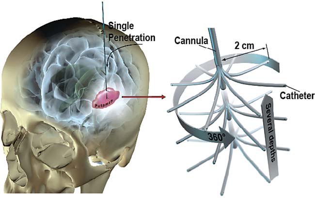 Moving Radially Branched Deployment_Neurosurgery_Lim