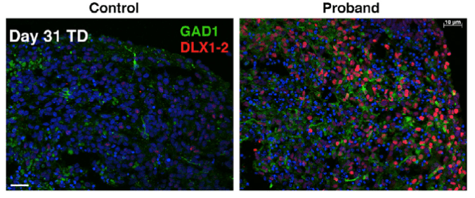 Fluorescent microscopy images of minibrain organoids derived from ASD patients (right) and unaffected family members (left). The red and green color indicate the increased presence of inhibitory neurons in the ASD minibrain (right). (Image credit: Mariani et al. Cell Volume 162, Issue 2, p375–390.