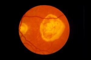 A retina of a patient with macular degeneration. (Photo credit: Paul Parker/SPL)