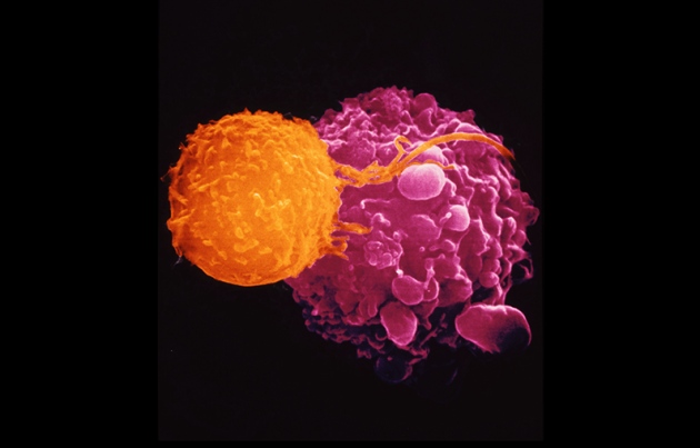 T-VEC recruits immune cells (orange) to attack cancer cells (pink) credit Dr. Andrejs Liepins/SPL