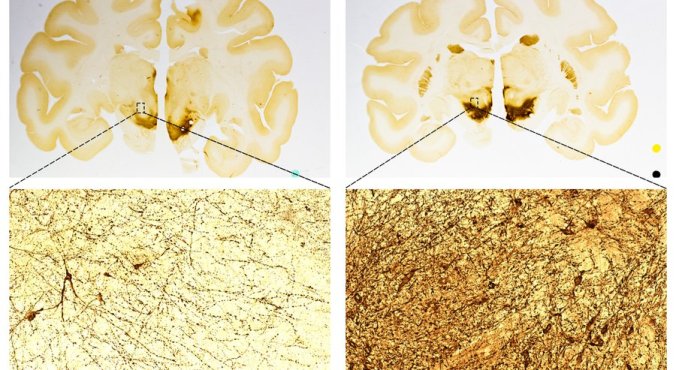 A comparison of primate brains to show an increase in the number of neurons after treatment with ISCO's stem cells. The left side is a control sample. The right side is from a treated brain. — International Stem Cell Corp.