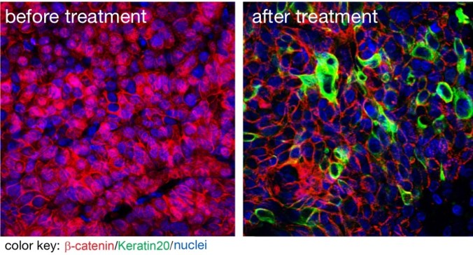 A new drug kills that cancer stem cells. The image on the left shows beta catenin (red) in cell nuclei indicating that these are cancer stem cells. The image on the right shows that the new substance sucessfully removed beta catenin from the nuclei. Picture by Liang Fang for the MDC