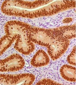 colon cancer stem cells