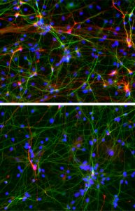 Neurons derived from people with ASD (bottom) form fewer inhibitory connections (red) compared to those derived from healthy individuals (top panel). (Salk Institute)