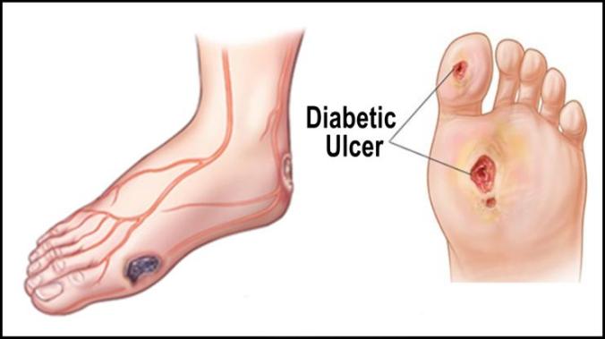 diabetic-foot-ulcers