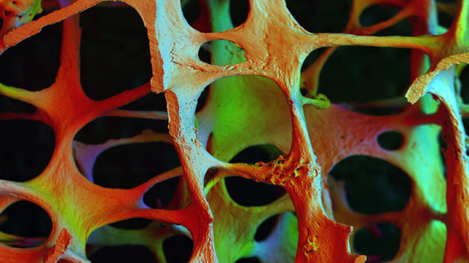 Electron microscope image showing the eroded, inner structure of a back bone in an 89 year old woman with osteoposis. Image courtesy the Bone Research Society 