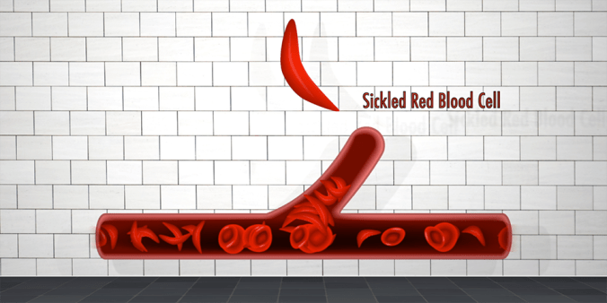 sickled-rbcs-960x480