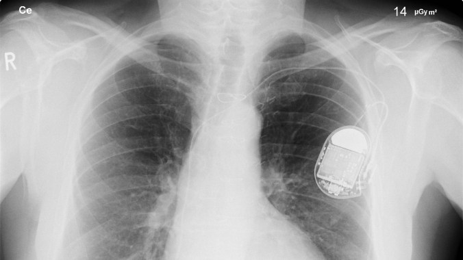 blog-pacemaker1920x1080