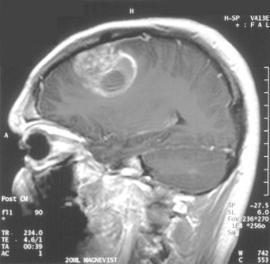 MRI scan of patient with glioblastoma tumor. (wikicommons)