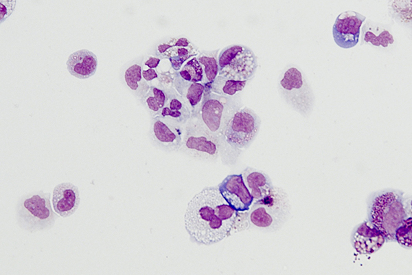 Red blood cells were successfully made via induced pluripotent stem cells from a Diamond-Blackfan anemia patient. Image: Daley lab, Boston Children’s