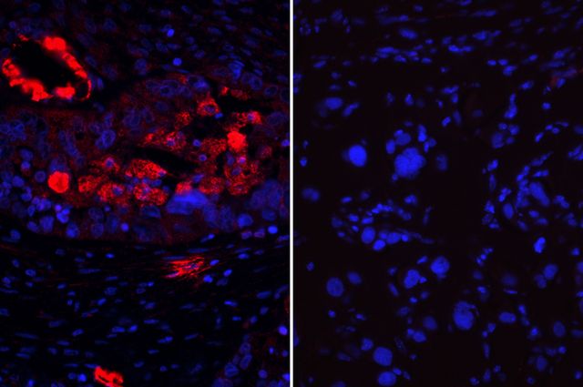 Ovarian+cancer+tumor+cells_mid