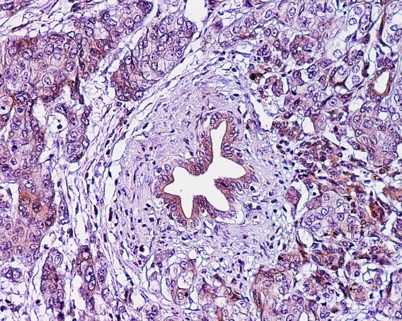 Zaret STM pancreatic cancer tissue July 17
