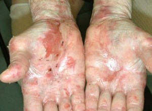 epidermolysis-bullosa-29502