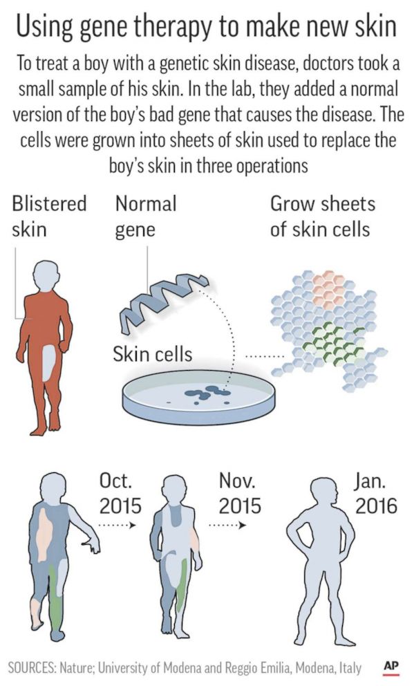 skin-gene-therapy-graphic-ap-ps-171108_3x5_992