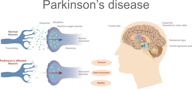 Parkinsonsshutterstock_604375424