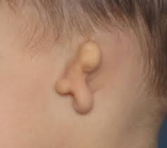 Microtia ear