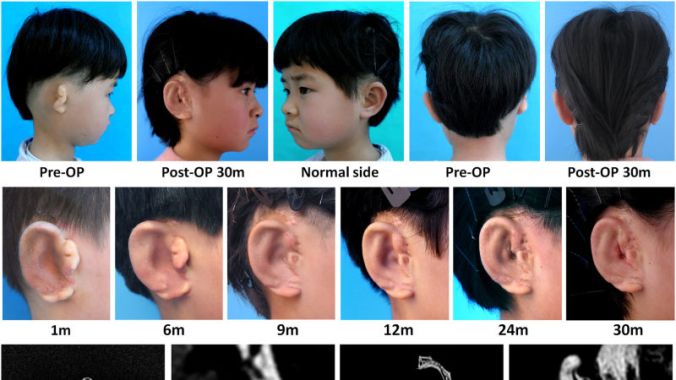 Microtia
