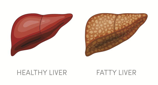 liver_fattyliver