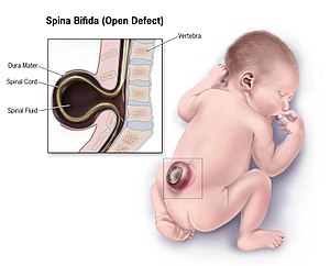 300px-Spina-bifida