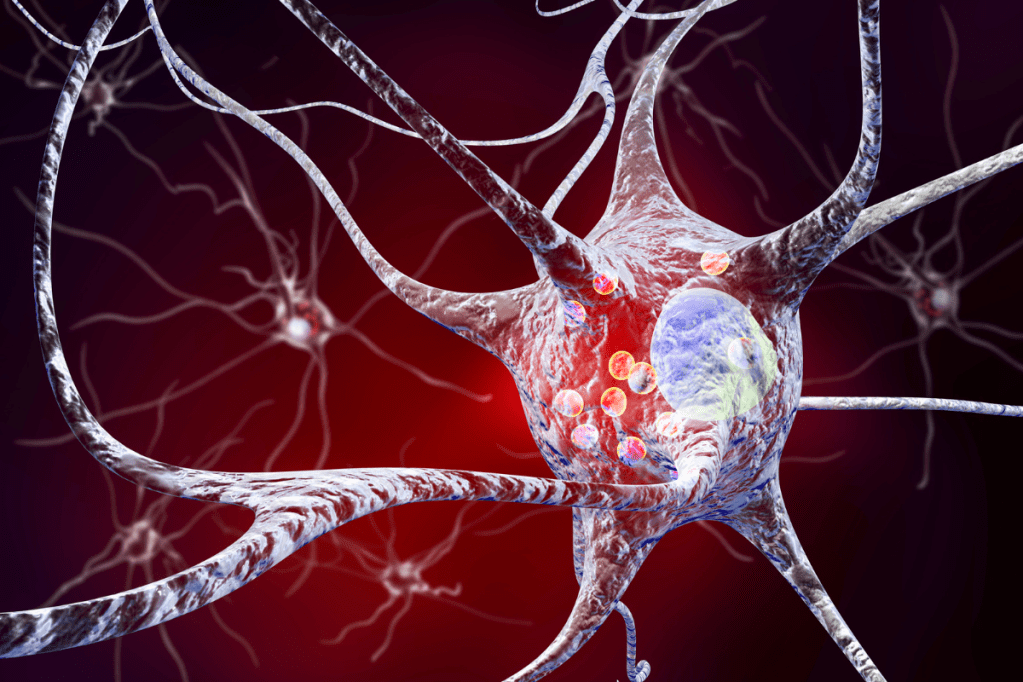Image of a Parkinson's disease nerve cell.