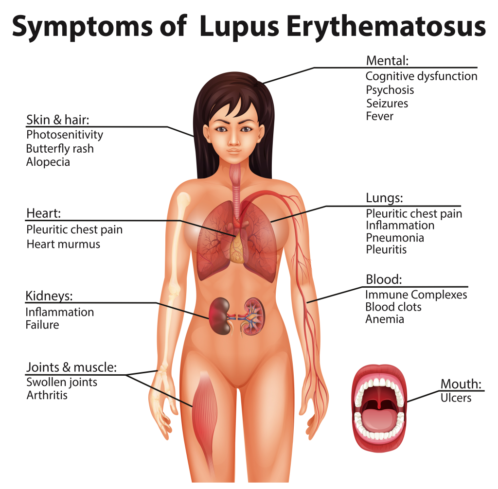 Anatomical diagram of Lupus Erythematosus symptoms.