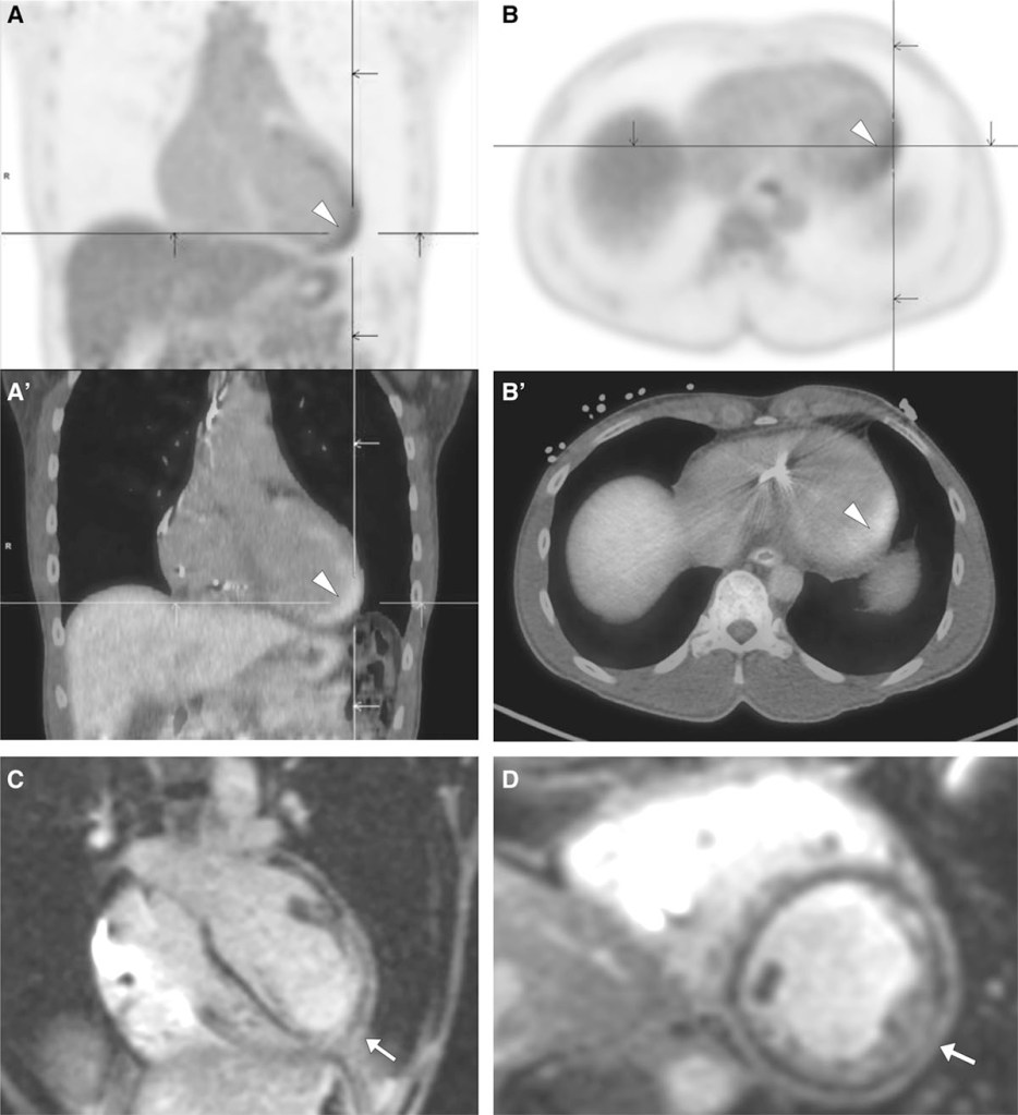 X-ray image of acute arrythmic heart